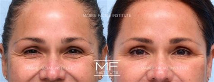 Does Botox help loose skin under chin?