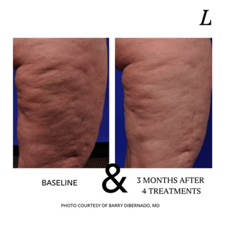 Does cellulite go away after pregnancy?