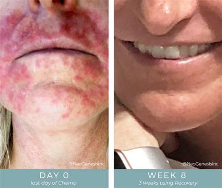 Does chemo always make you sick?