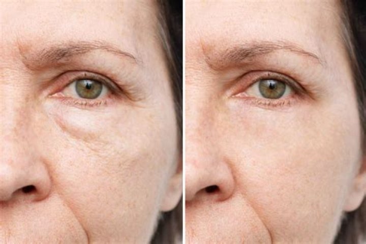 Does Dermarolling help eye bags?