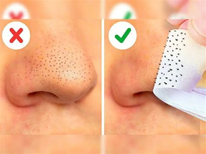 Does egg get rid of blackheads?
