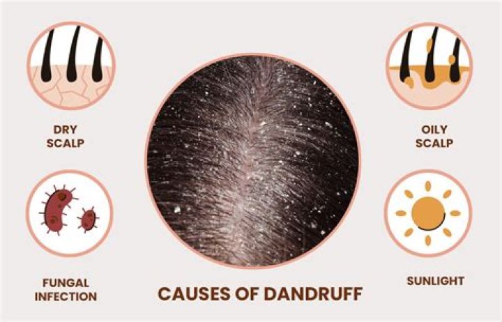 Does everyone have dandruff?
