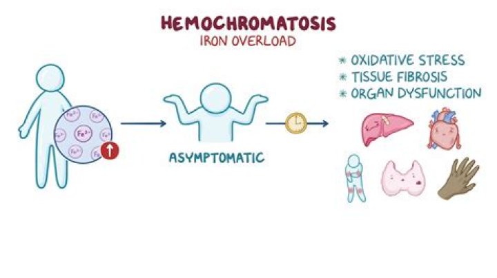 Does giving blood help hemochromatosis?