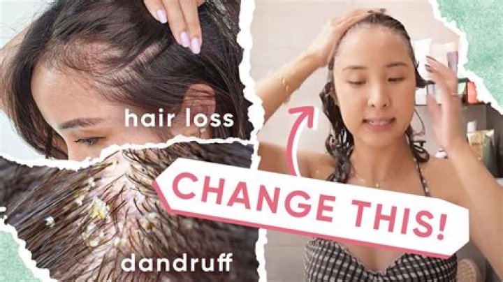 Does going to bed with wet hair cause dandruff?