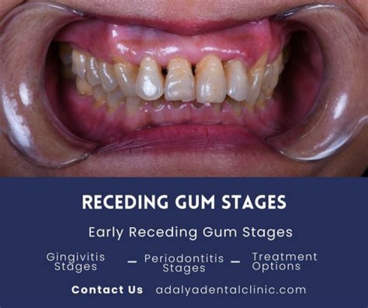 Does green tea help receding gums?