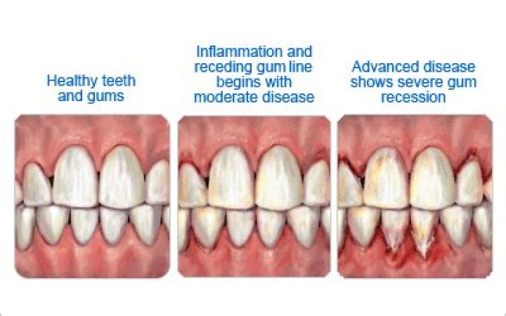 Does gum inflammation go away?