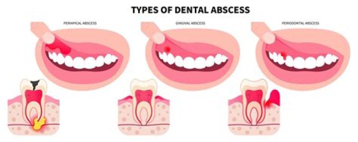 Does heat make an abscess worse?