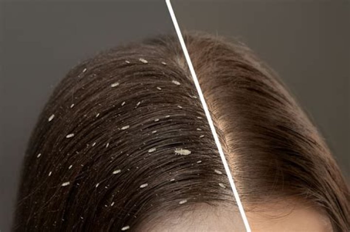 Does lice ever go away?