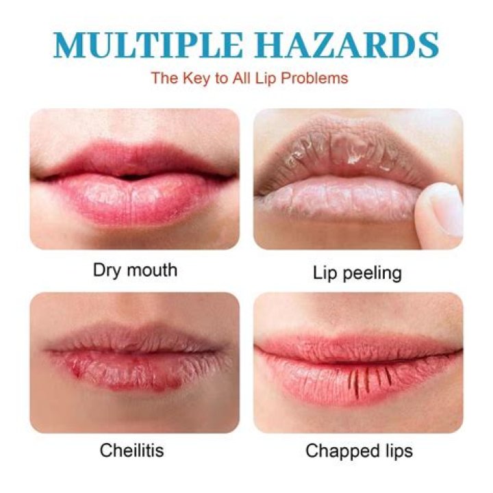 Does licking dry lips make it worse?