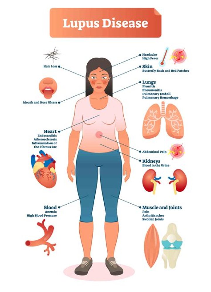 Does lupus affect your gut?