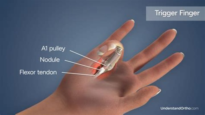 Does lupus cause trigger finger?