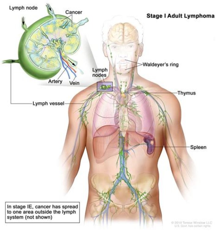 Does lymphoma start in one node?