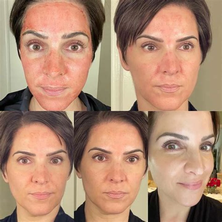 Does microneedling hurt?