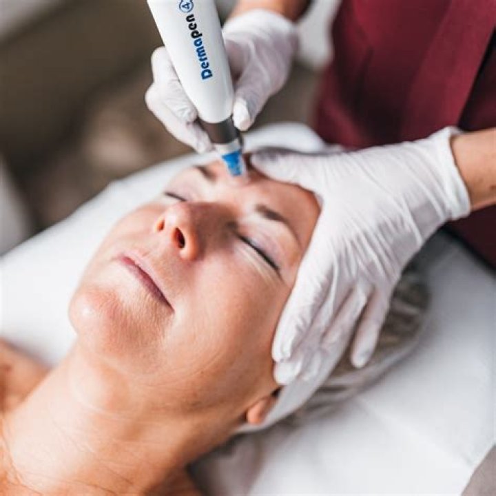 Does microneedling remove pigmentation?
