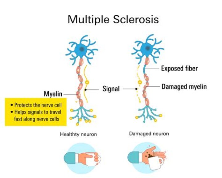 Does multiple sclerosis affect driving?