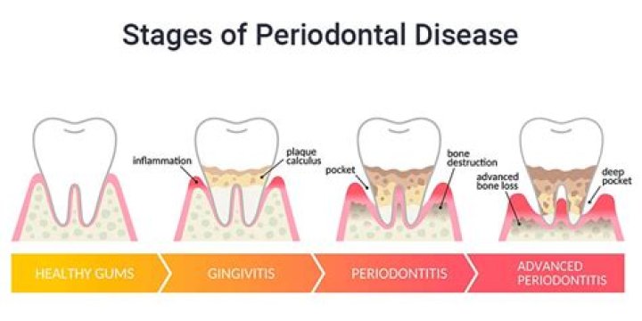 Does periodontal disease go away after treatment?