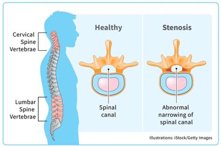 Does spinal stenosis affect both legs?