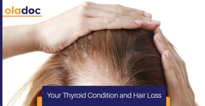 Does thyroid cause hair loss?