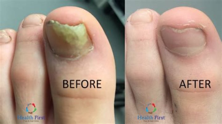 Does Vicks take away toenail fungus?