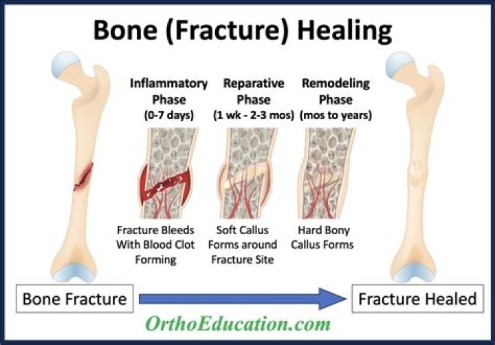 Does vitamin D Help fracture healing?