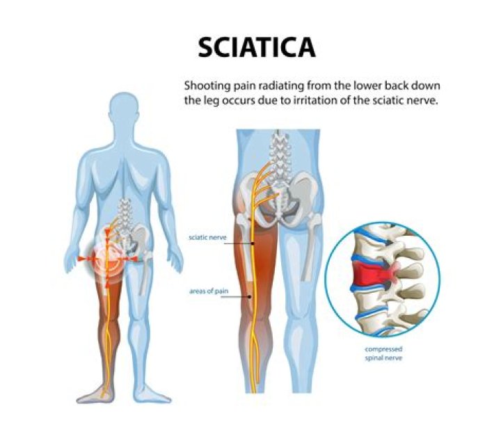 Does walking worsen sciatica?