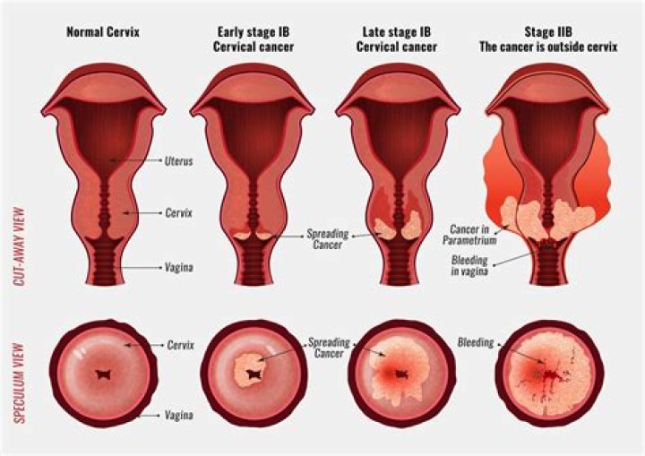 Does your cervix grow back after colposcopy?