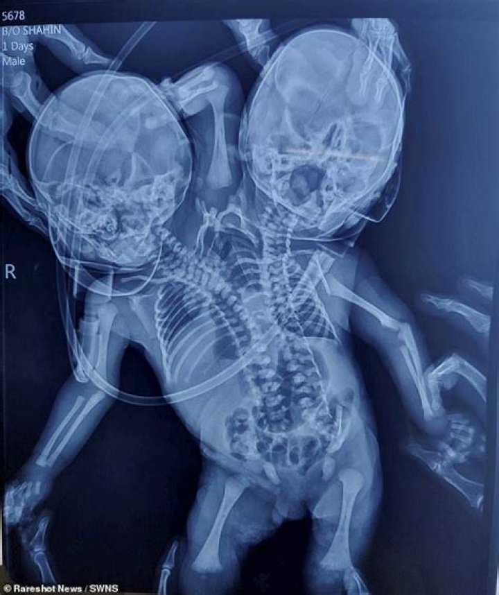 Has anyone been born with 2 heads?