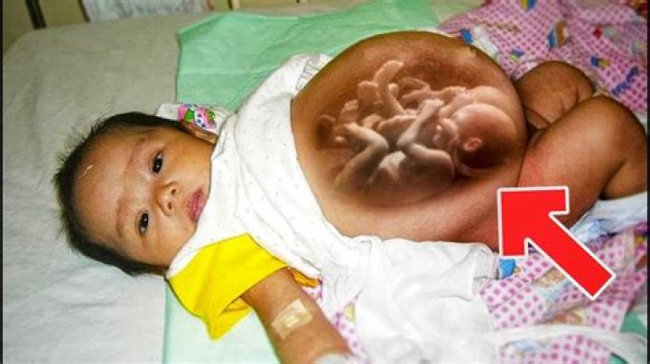 How a baby is born from mother's stomach?