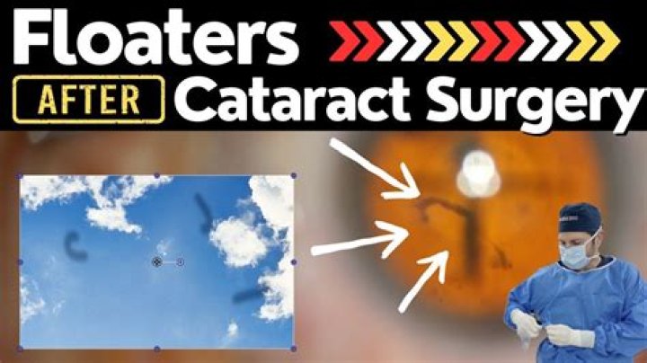 How are floaters treated after cataract surgery?