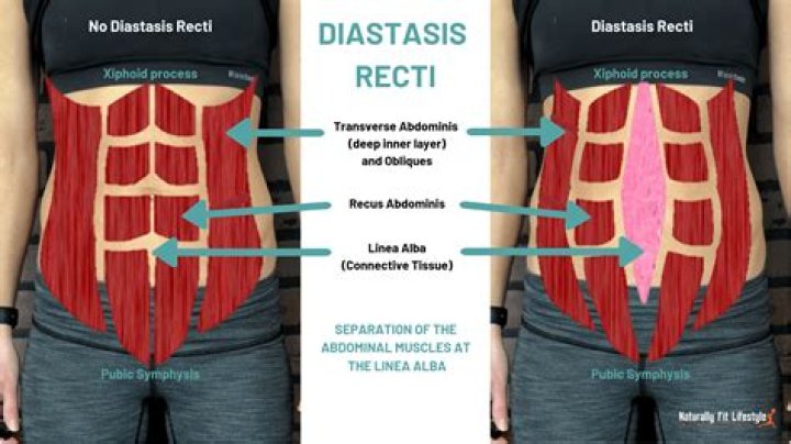 How big can diastasis recti get?