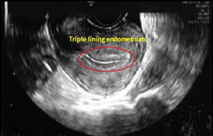 How can I improve my uterus lining?