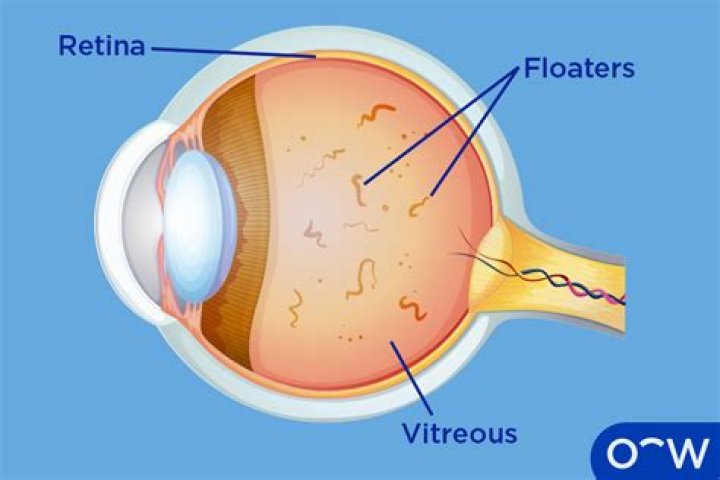 How can I naturally get rid of eye floaters?