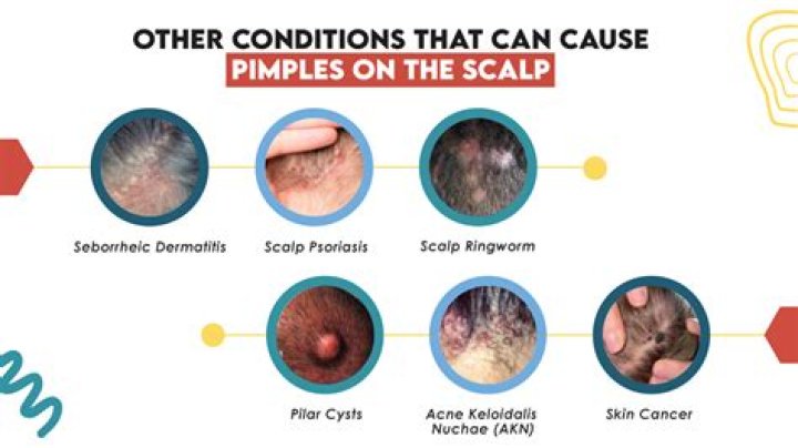 How can I soothe my scalp after chemo?