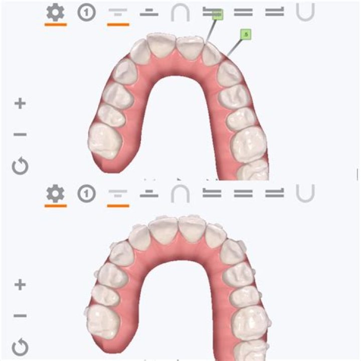 How can I speed up the movement of my teeth?