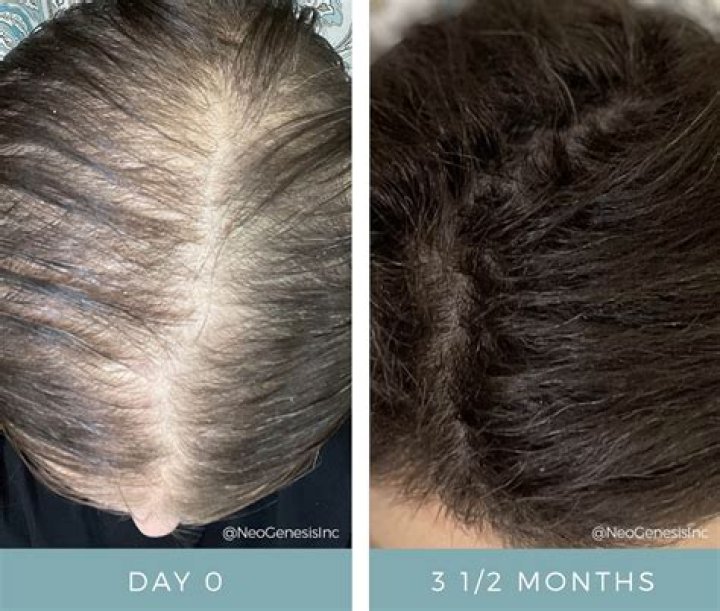 How can I stop my hair from falling out after chemo?