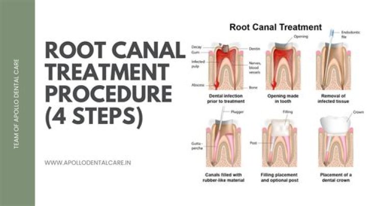 How common is root canal failure?