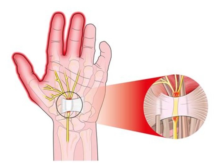 How do I get instant relief from carpal tunnel?