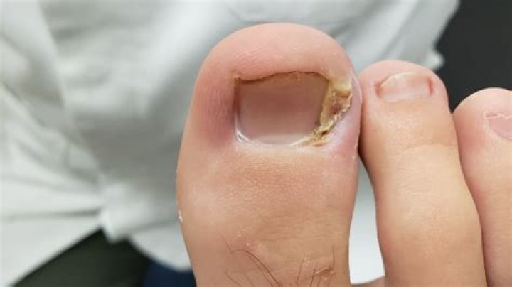 How do I get rid of painful gas?