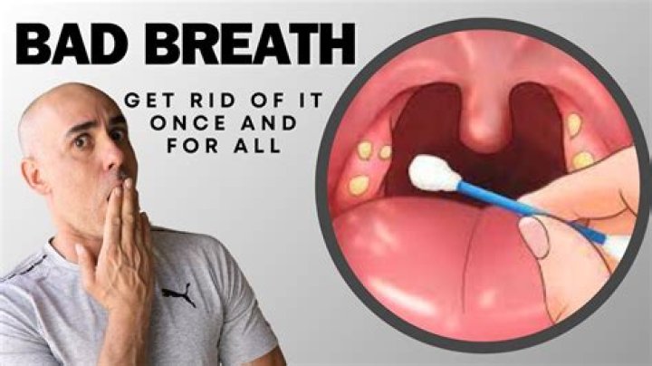 How do I get rid of the smelly balls in my throat?