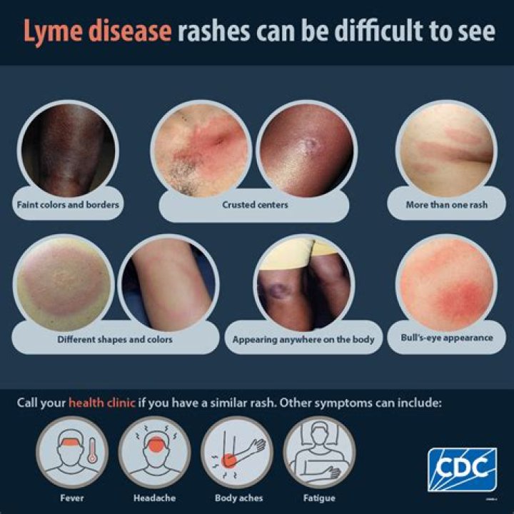 How do I know if I have a tick bite?