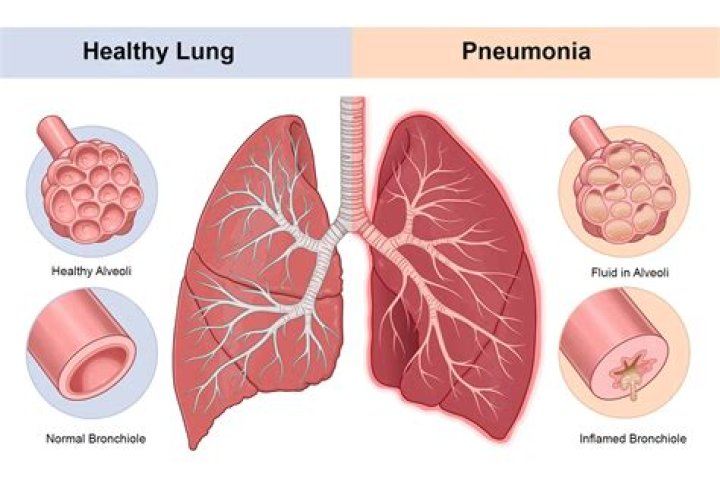 How do I know if I have pneumonia with Covid?