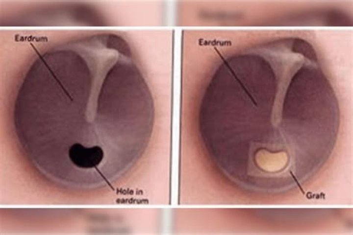 How do I know if I ruptured my eardrum?