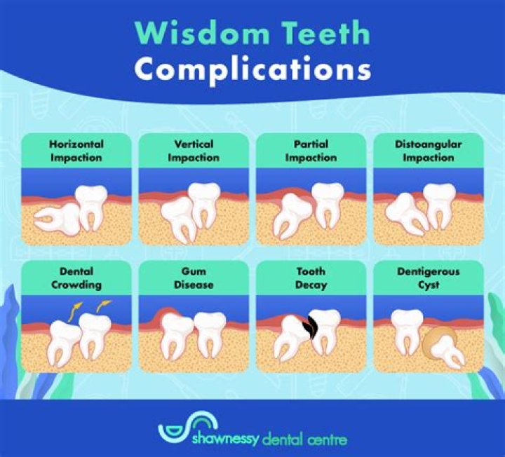 How do I know if my wisdom teeth are coming in correctly?