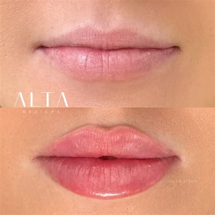 How do Russians get flat lips?