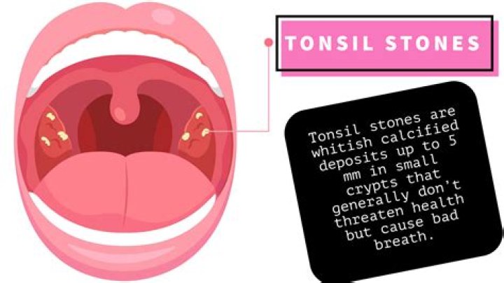 How do you break up tonsil stones?