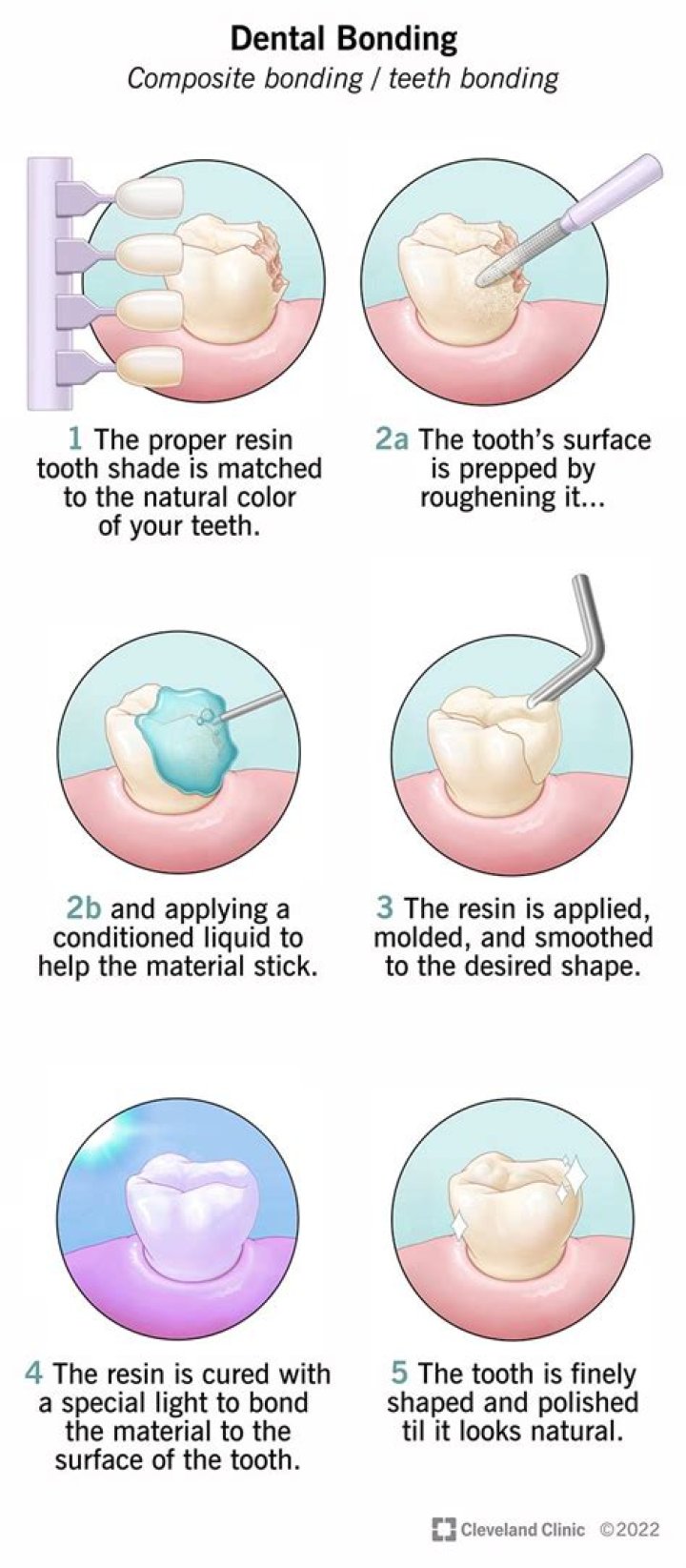 How do you clean bonded teeth?