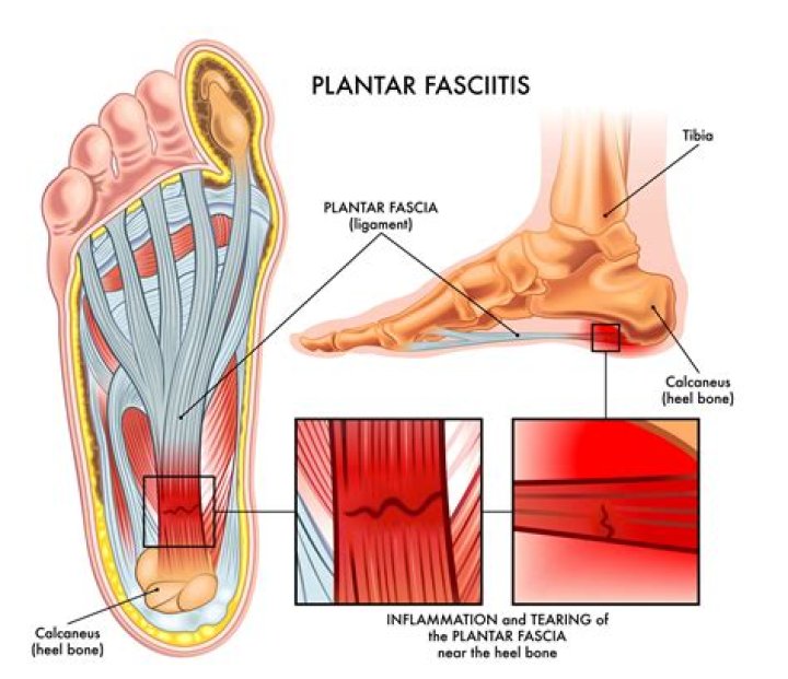 How do you confirm plantar fasciitis?