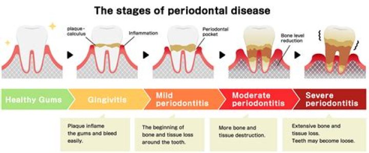 How do you determine severity of periodontal disease?