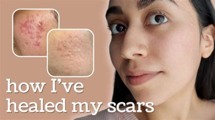 How do you fix an indented face scar?