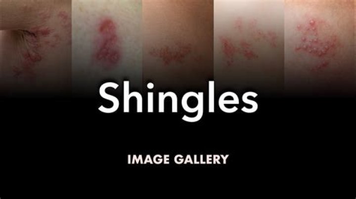 How do you fix fish mouth shingles?